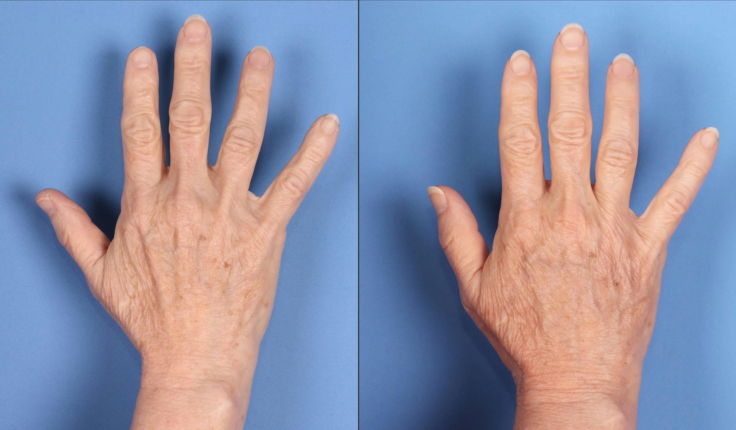 Fat Grafting to Hands Before & After Gallery - Patient 657160 - Image 2