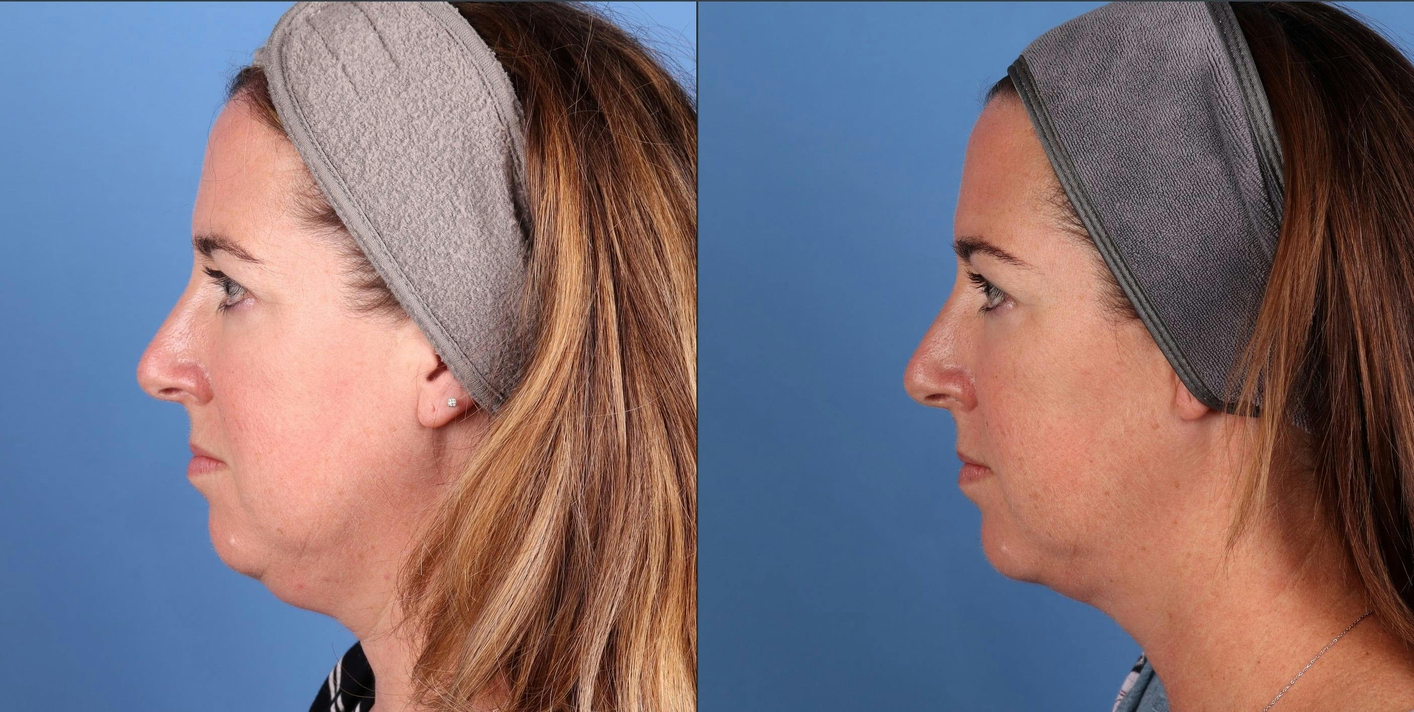 Face & Neck Before & After Gallery - Patient 278330 - Image 3
