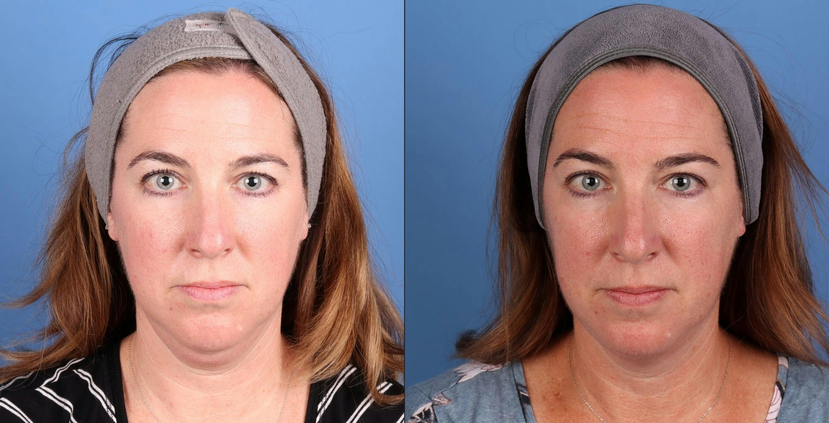 Face & Neck Before & After Gallery - Patient 278330 - Image 1