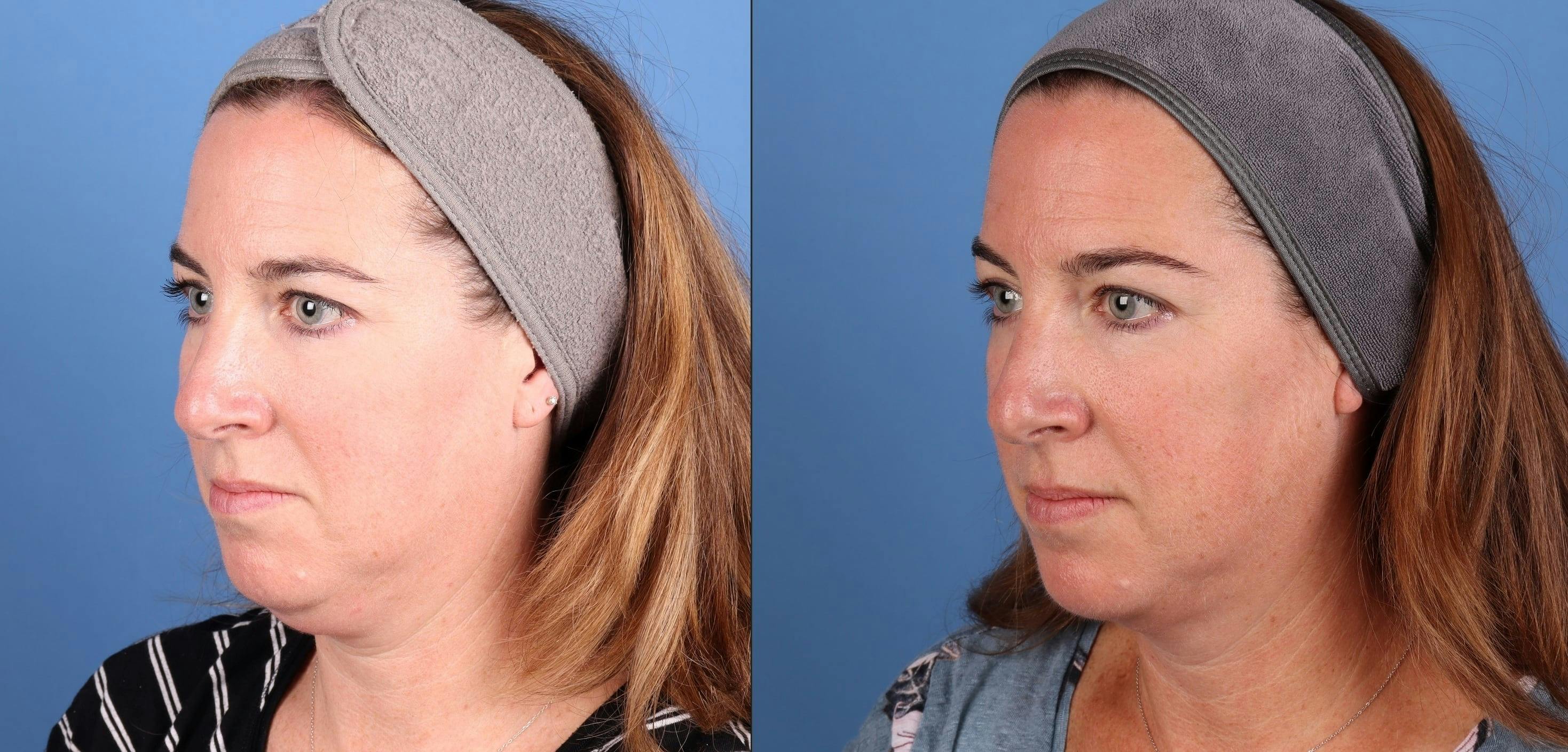 Face & Neck Before & After Gallery - Patient 278330 - Image 2