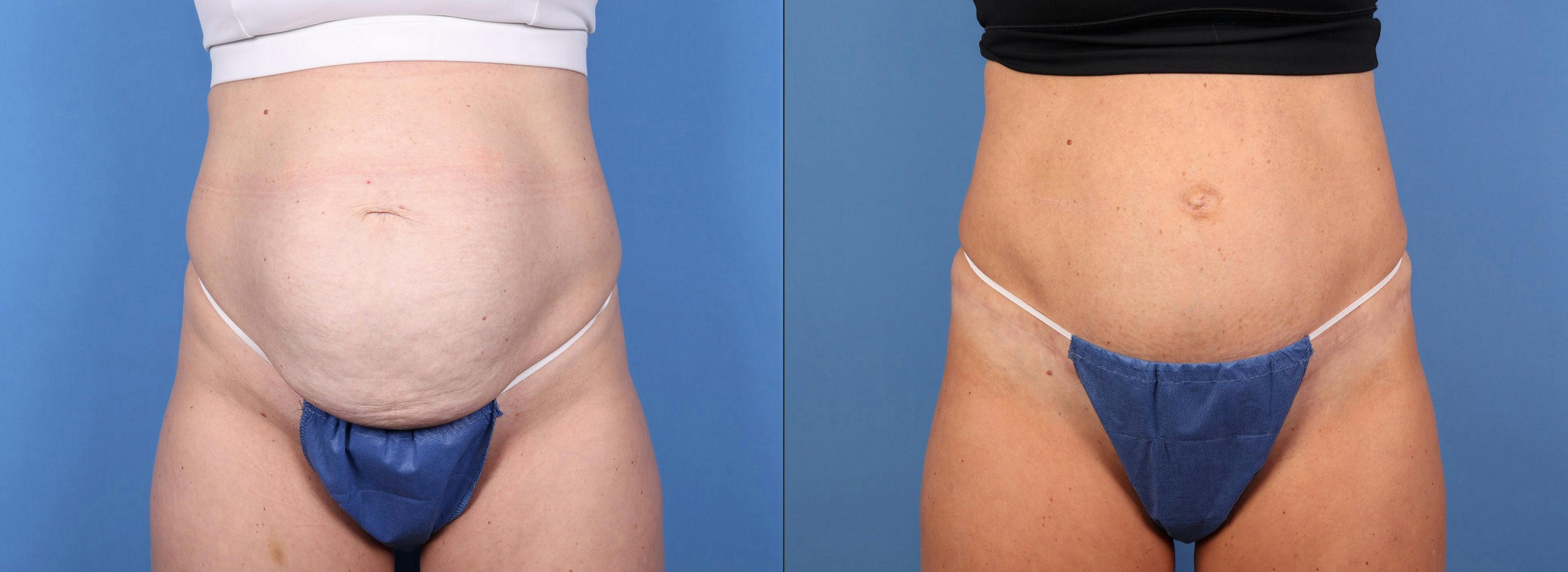 Tummy Tuck Before & After Gallery - Patient 155998 - Image 1