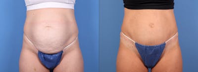 Tummy Tuck Before & After Gallery - Patient 155998 - Image 1