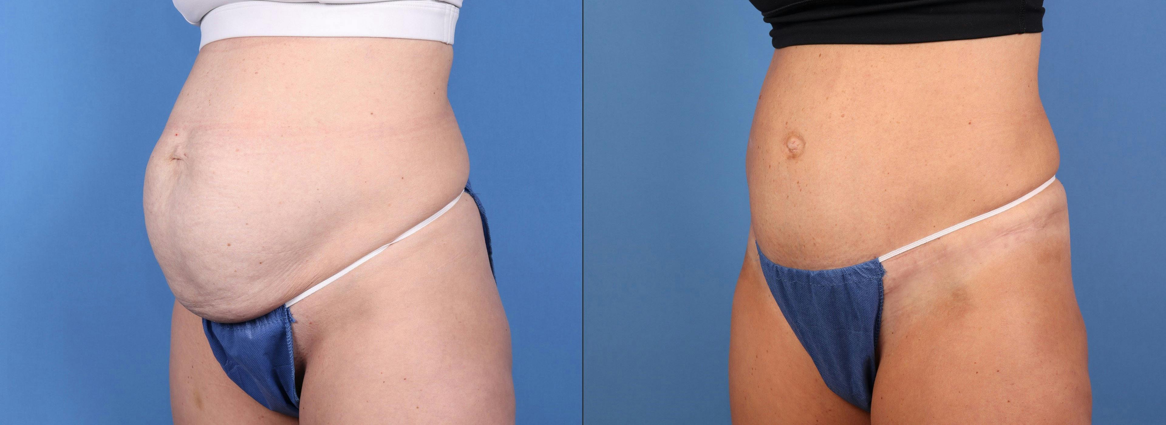 Tummy Tuck Before & After Gallery - Patient 155998 - Image 2
