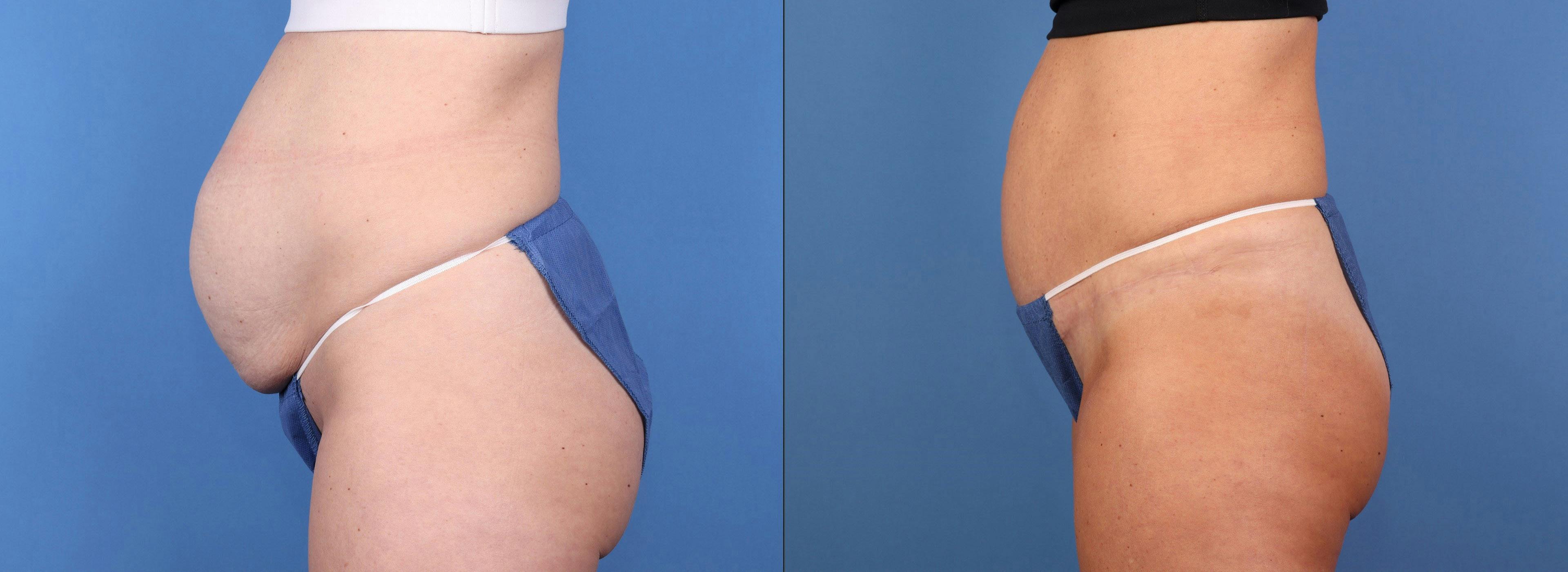 Tummy Tuck Before & After Gallery - Patient 155998 - Image 3