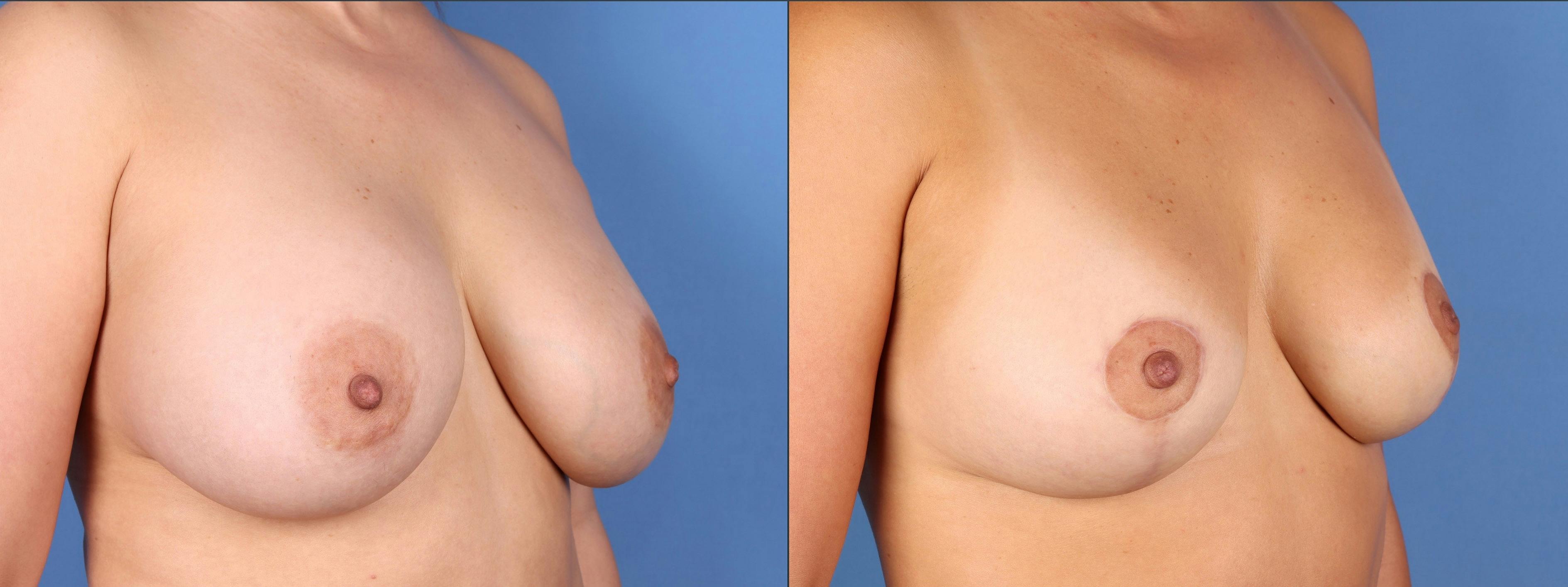 Breast Lift Before & After Gallery - Patient 653320 - Image 2