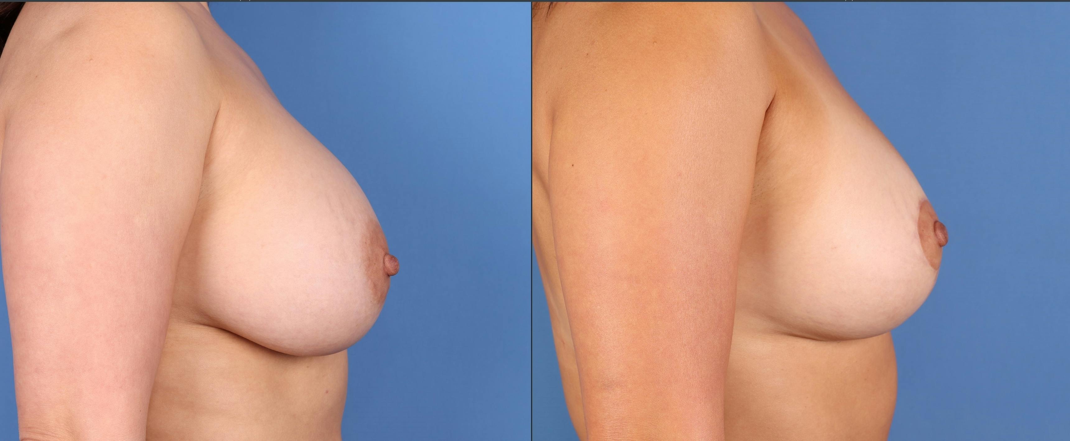 Breast Lift Before & After Gallery - Patient 653320 - Image 3