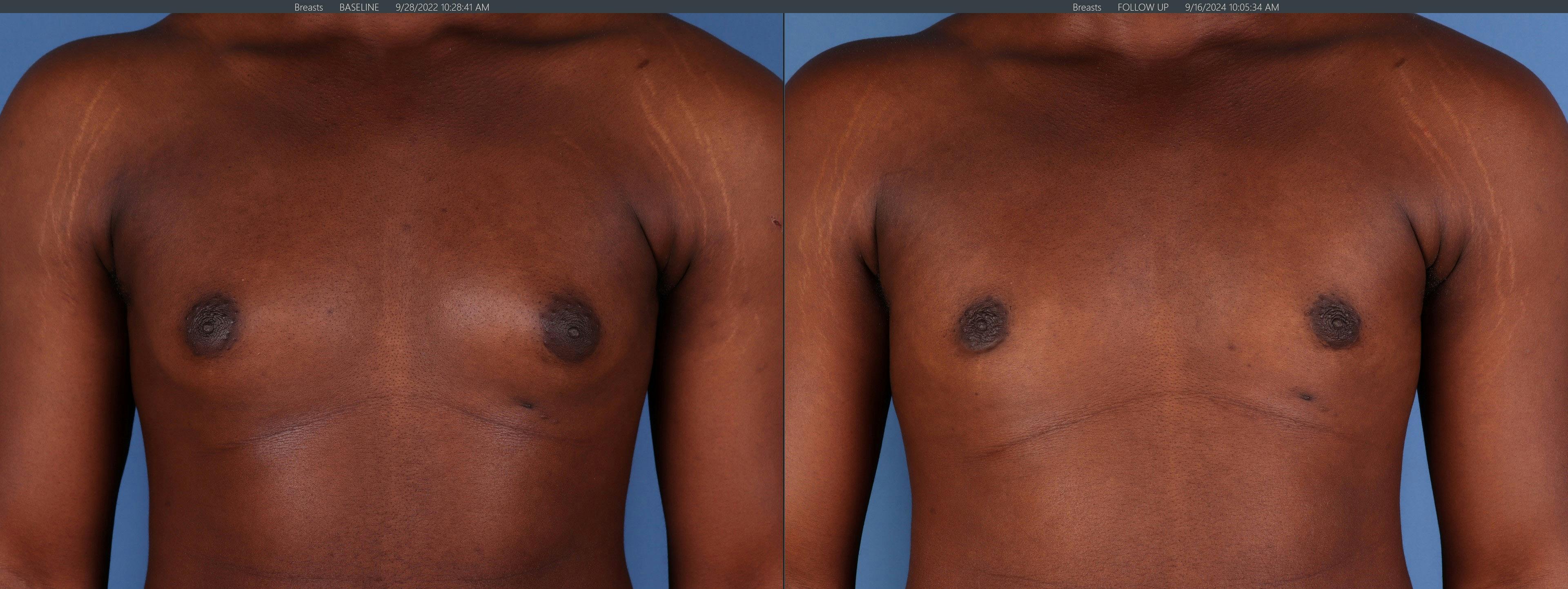 Male Breast Reduction Before & After Gallery - Patient 184121 - Image 1