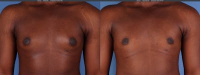 Male Breast Reduction Before & After Gallery - Patient 239489 - Image 1