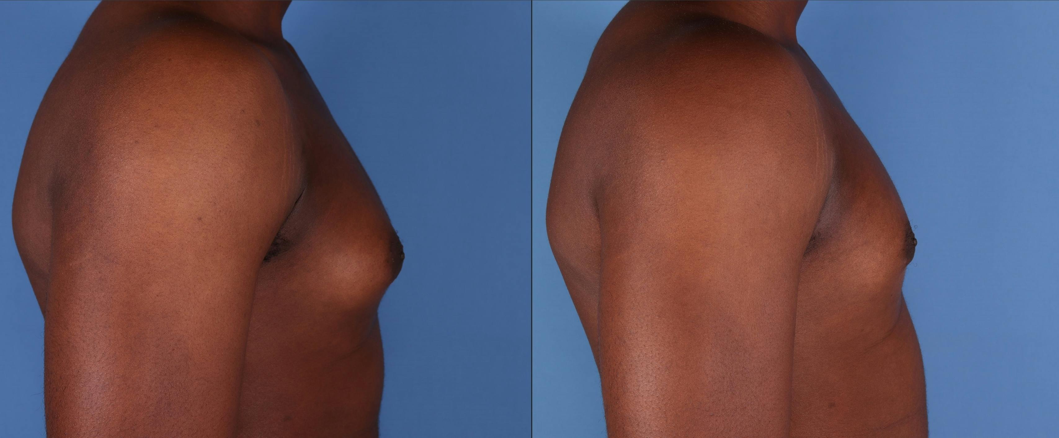 Male Breast Reduction Before & After Gallery - Patient 184121 - Image 3
