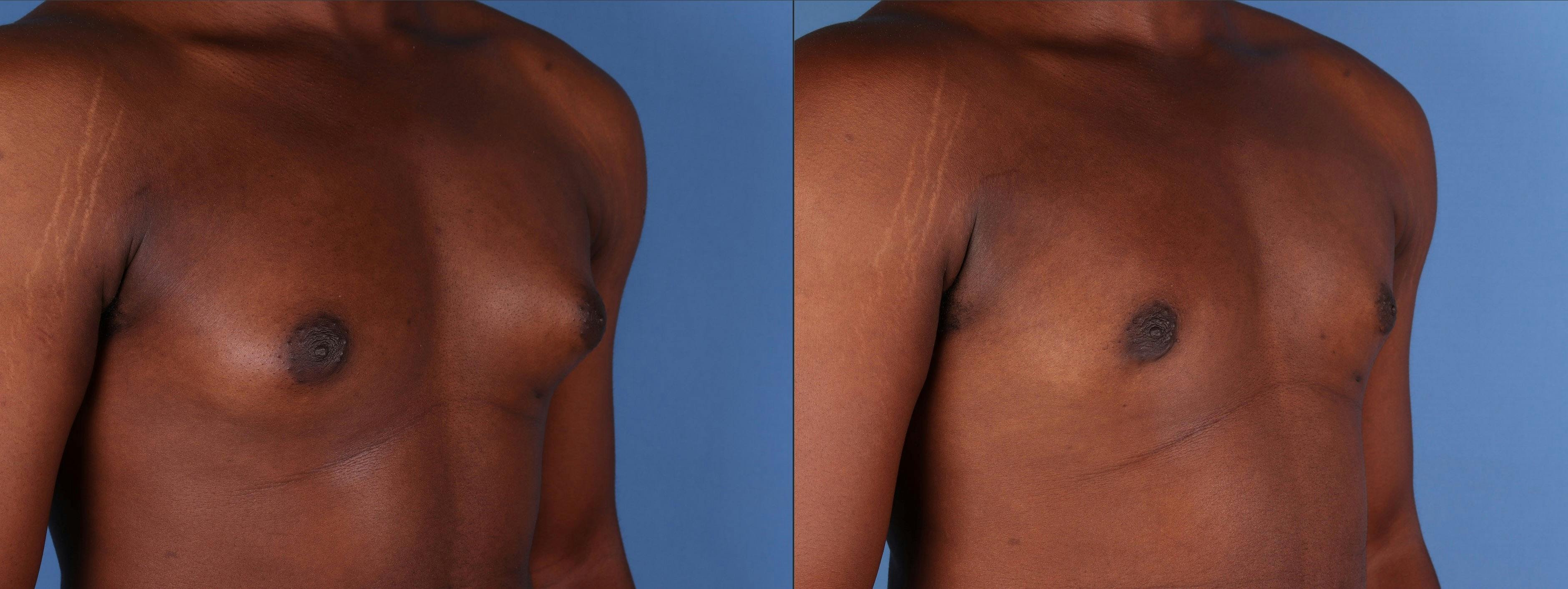Male Breast Reduction Before & After Gallery - Patient 184121 - Image 2