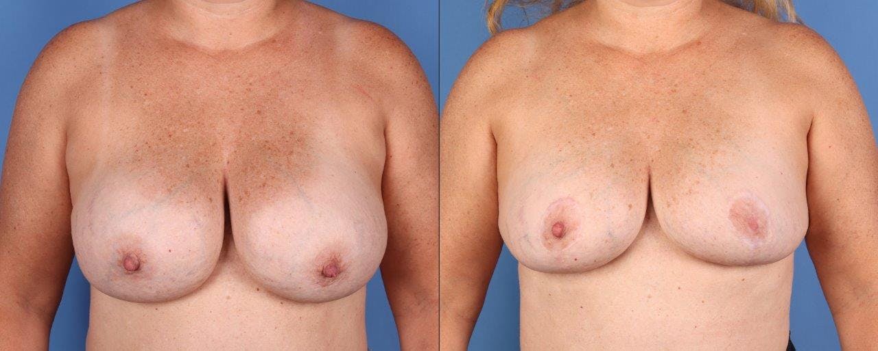 Breast Revision Before & After Gallery - Patient 295978 - Image 1