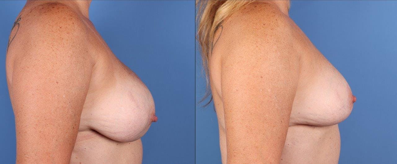 Breast Revision Before & After Gallery - Patient 295978 - Image 3