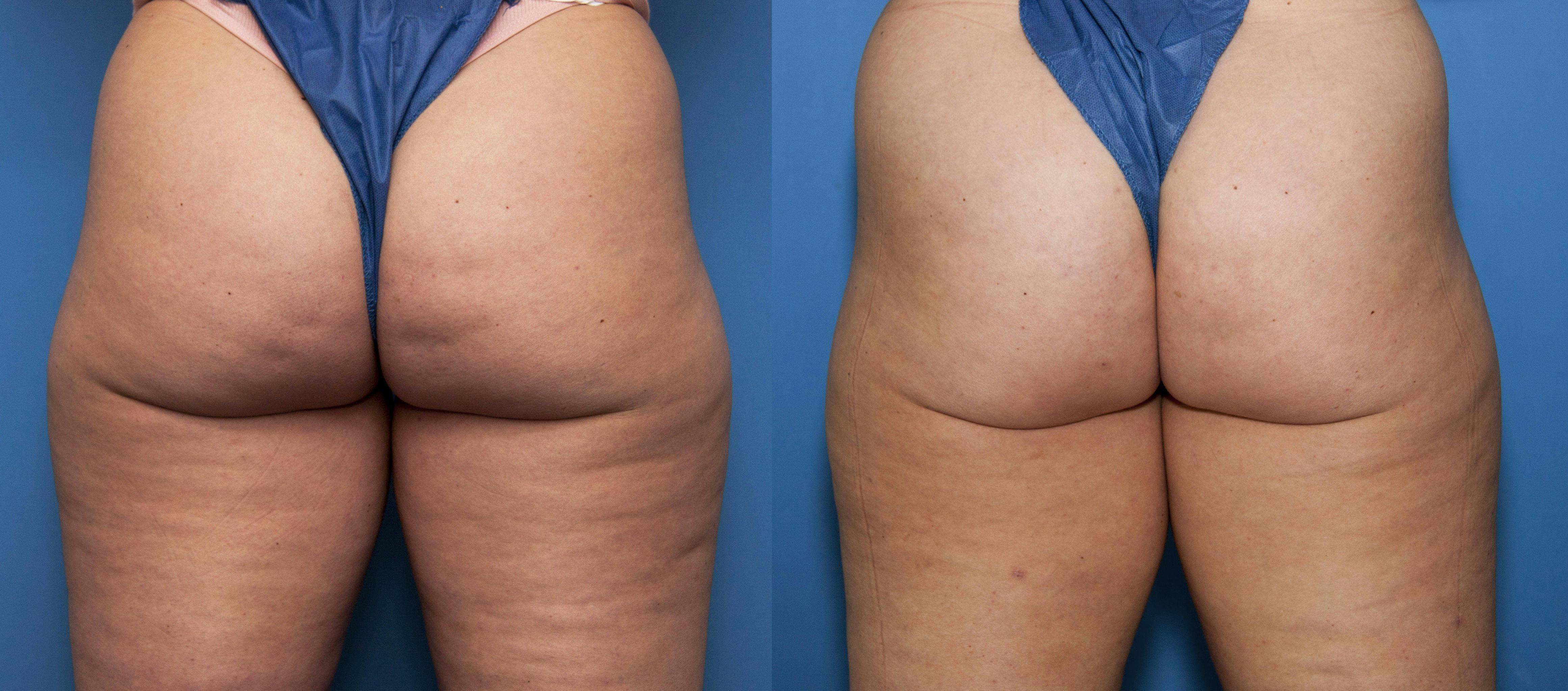 Cellulite Treatment Before & After Gallery - Patient 348839 - Image 1