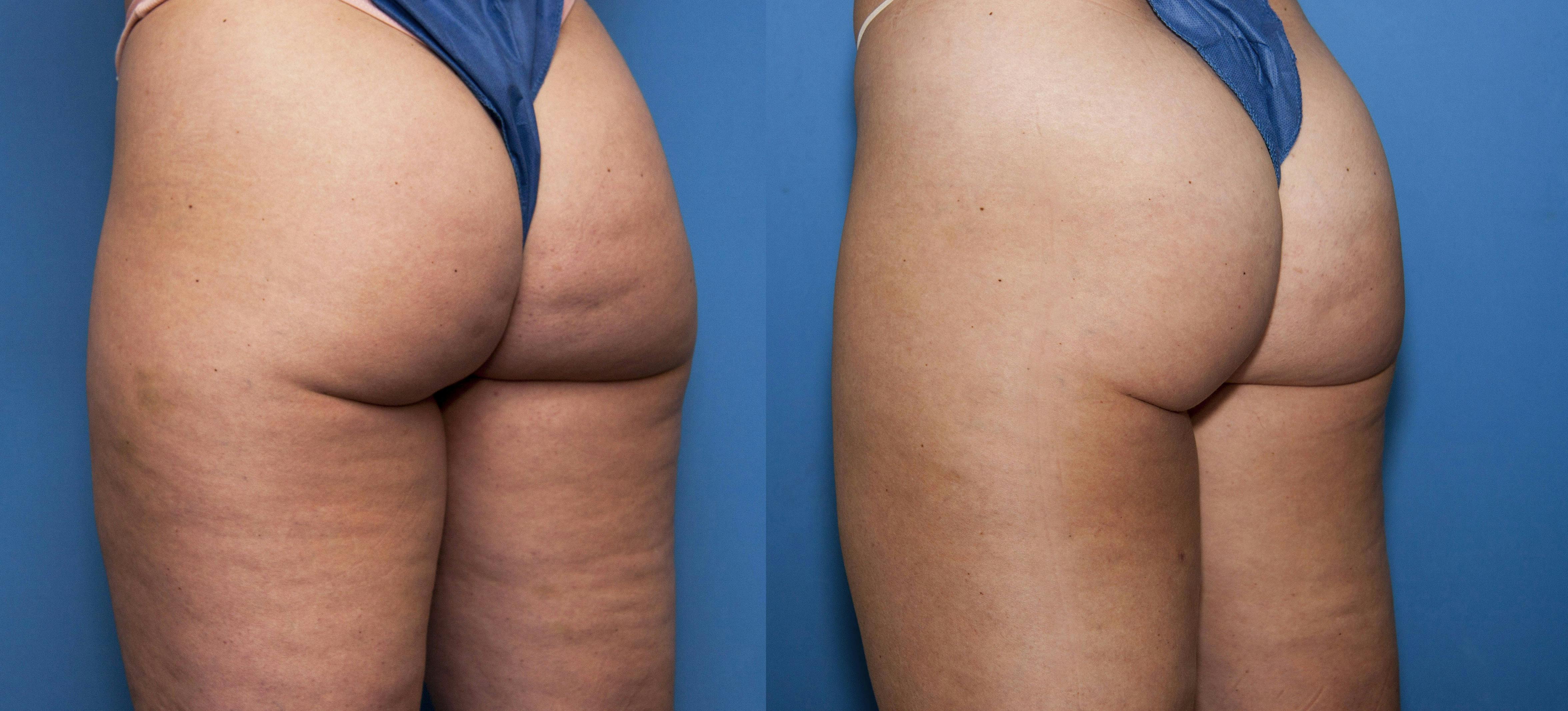 Cellulite Treatment Before & After Gallery - Patient 348839 - Image 3