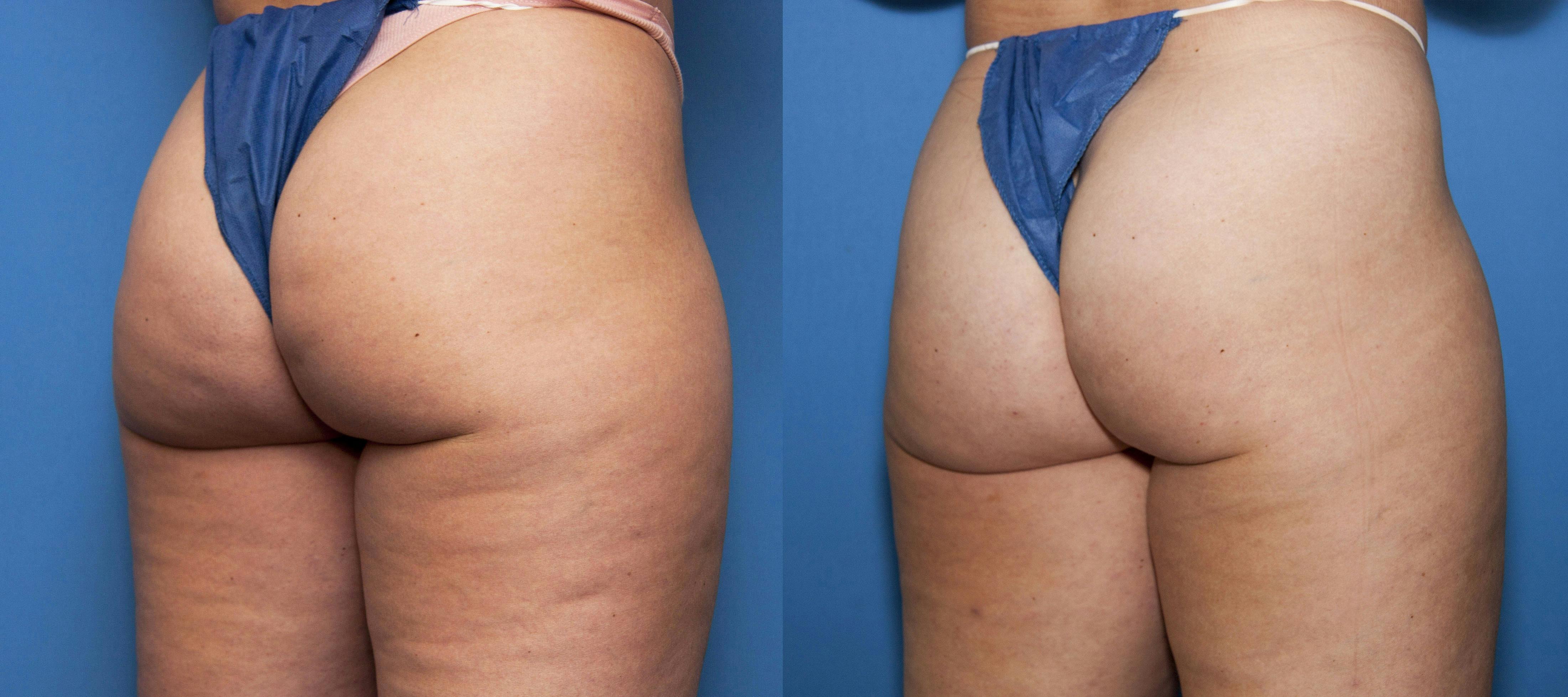 Cellulite Treatment Before & After Gallery - Patient 348839 - Image 2