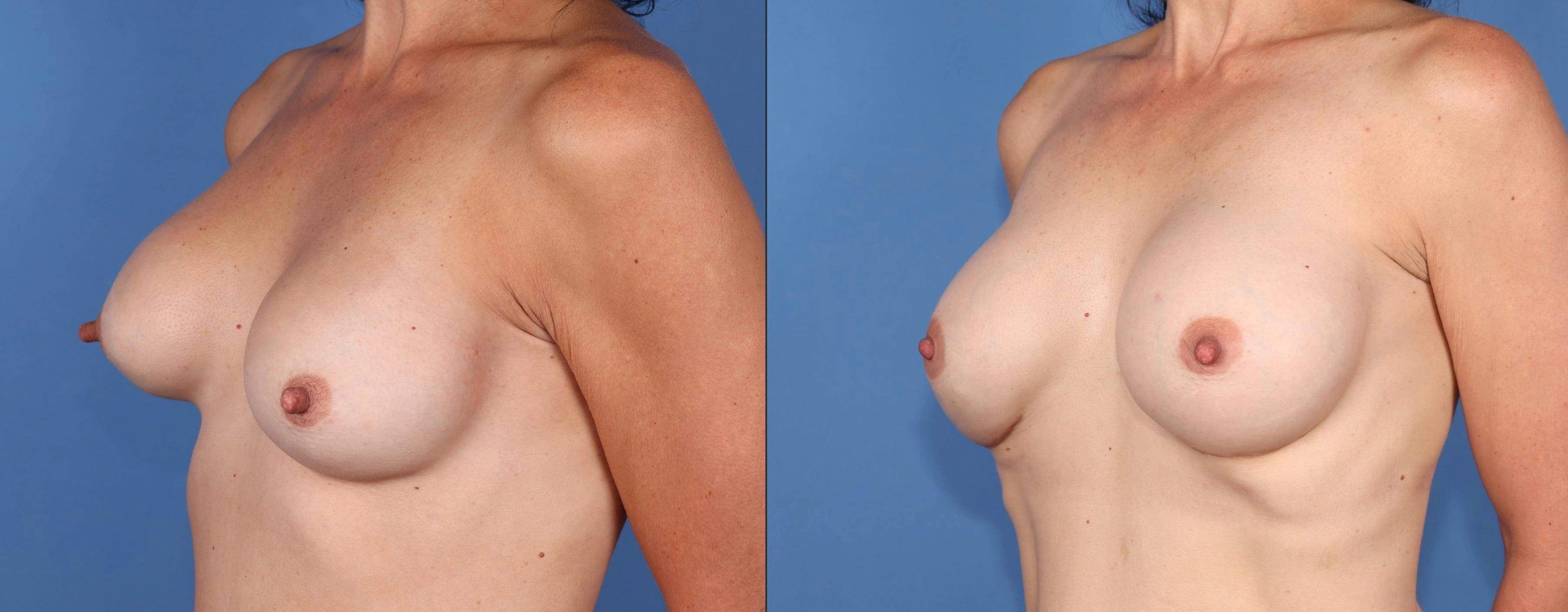 Breast Revision Before & After Gallery - Patient 396792 - Image 2