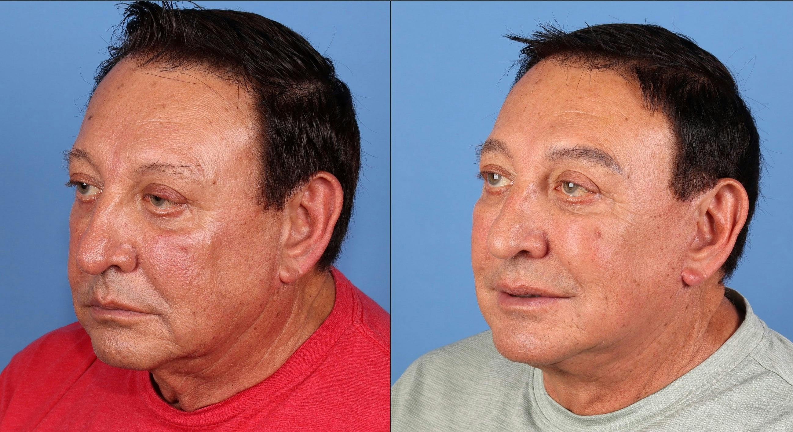 Face Lift Before & After Gallery - Patient 153633 - Image 2
