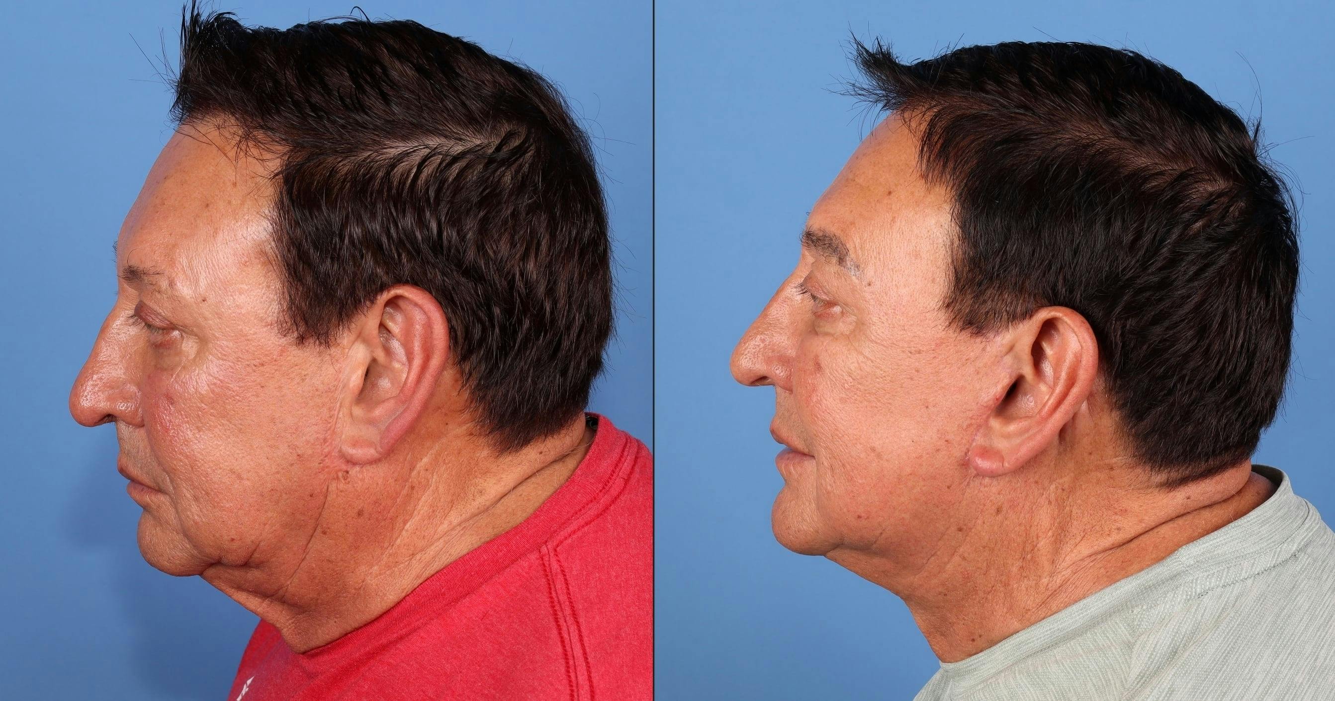 Neck Lift Before & After Gallery - Patient 189573 - Image 1