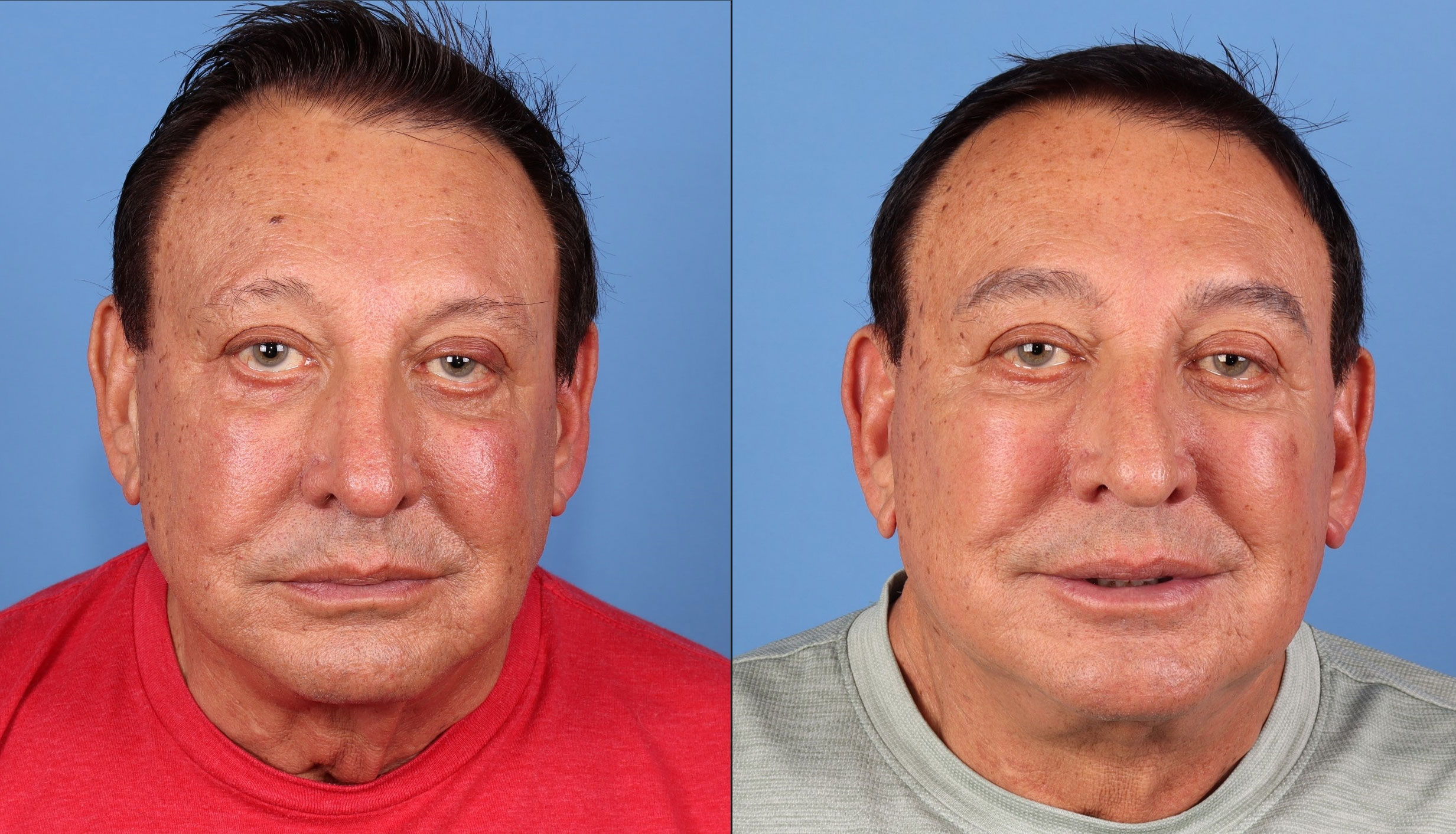 Patient 153633 | Facelift for Men Before & After Photos | Dr. Guy