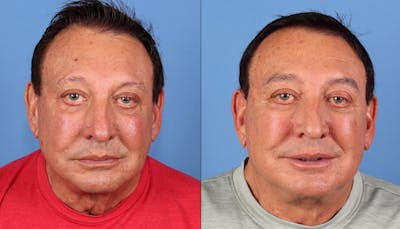 Face Lift Before & After Gallery - Patient 399474 - Image 1