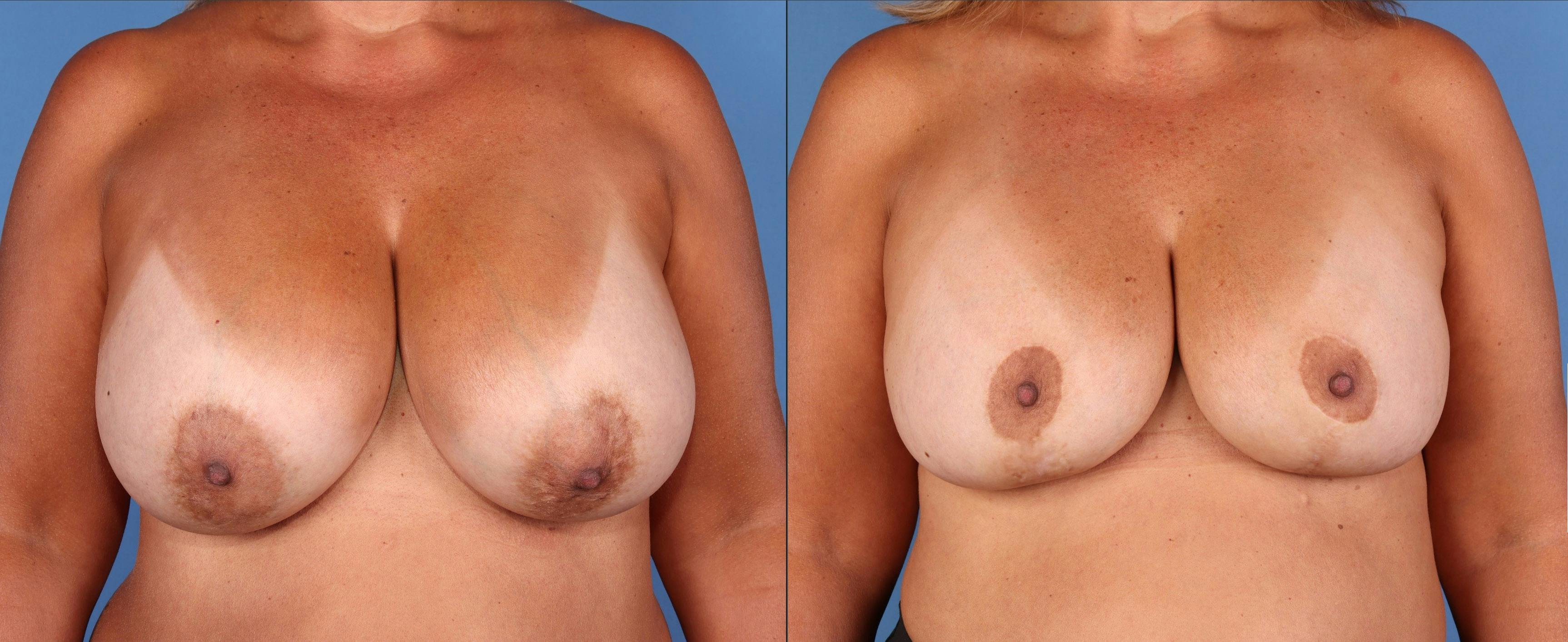 Breast Lift with Augmentation Before & After Gallery - Patient 283336 - Image 1
