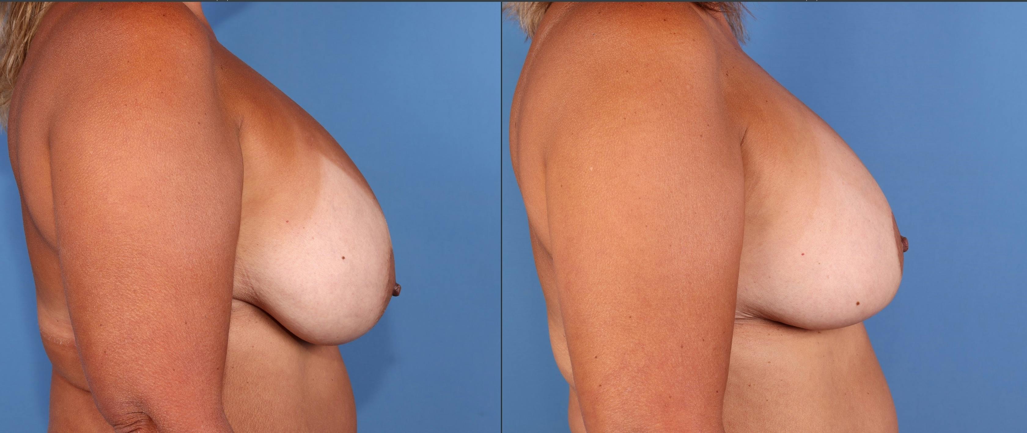 Breast Revision Before & After Gallery - Patient 208500 - Image 3