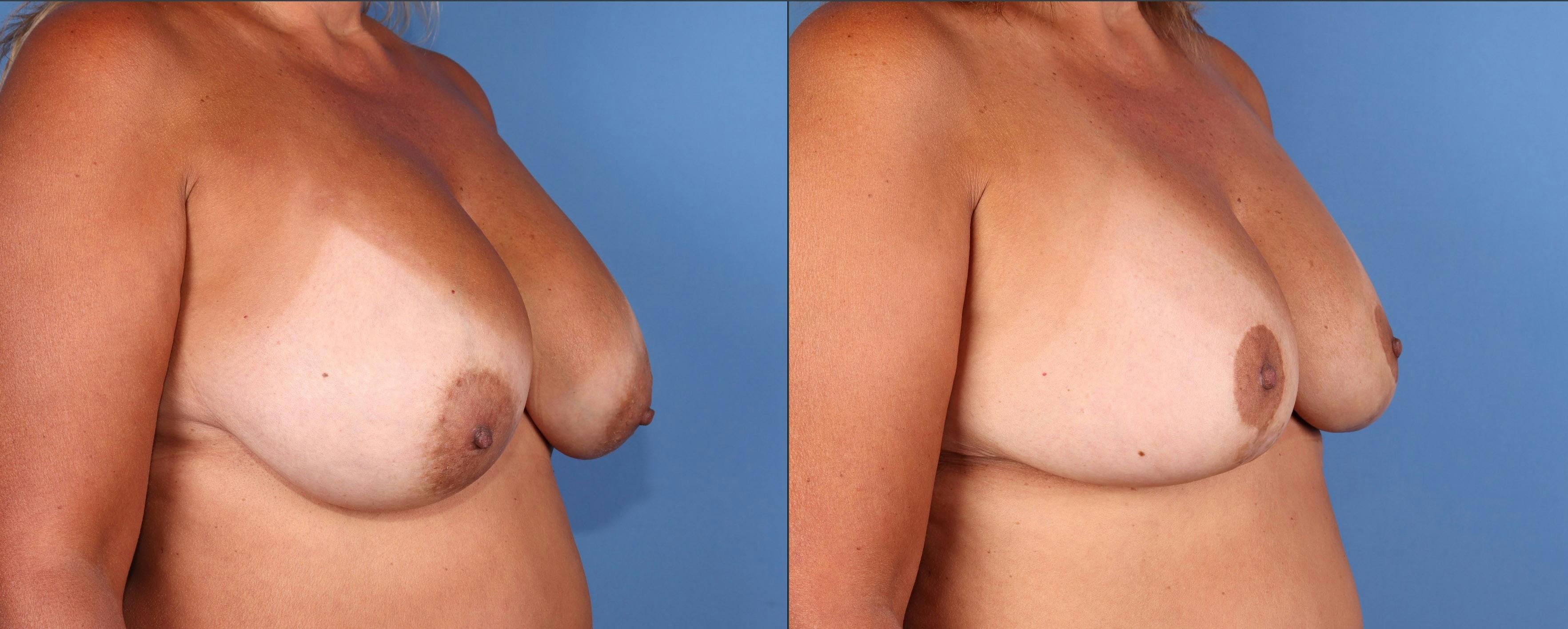 Breast Revision Before & After Gallery - Patient 208500 - Image 2