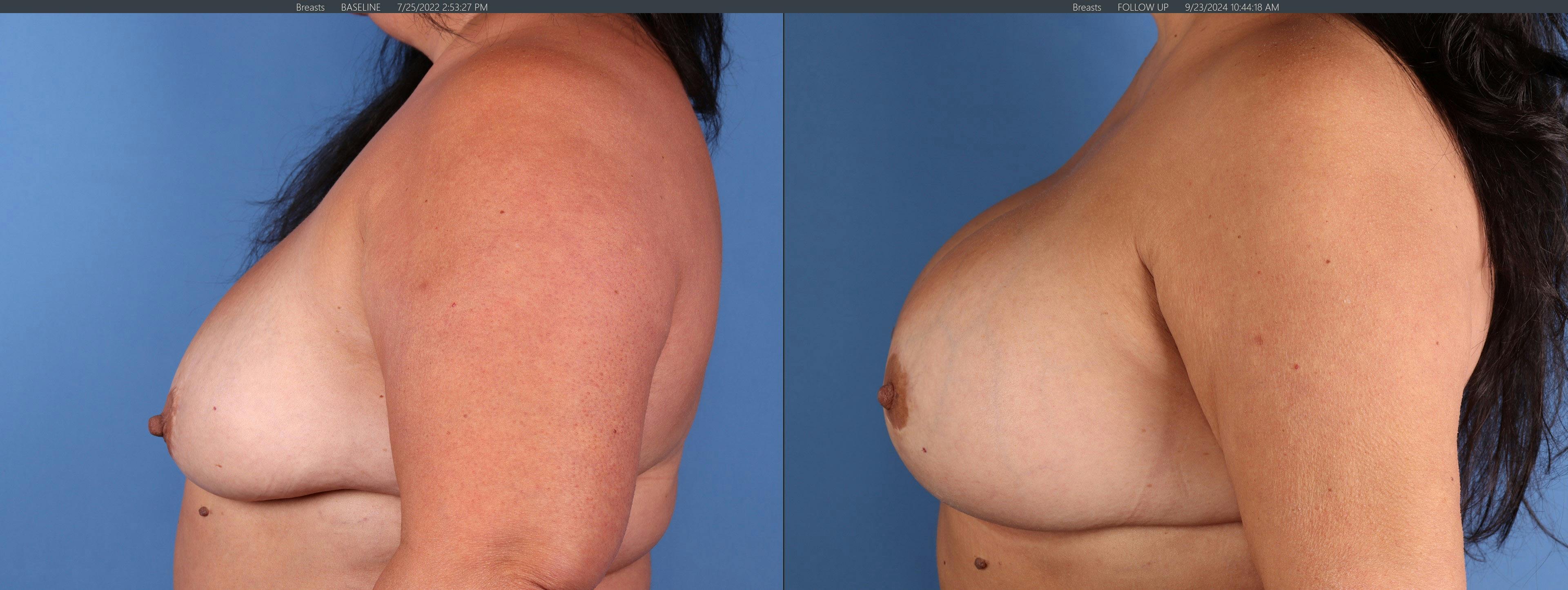 Breast Lift with Augmentation Before & After Gallery - Patient 411732 - Image 3
