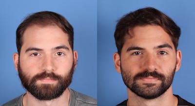 NeoGraft Hair Restoration Before & After Gallery - Patient 120198 - Image 1