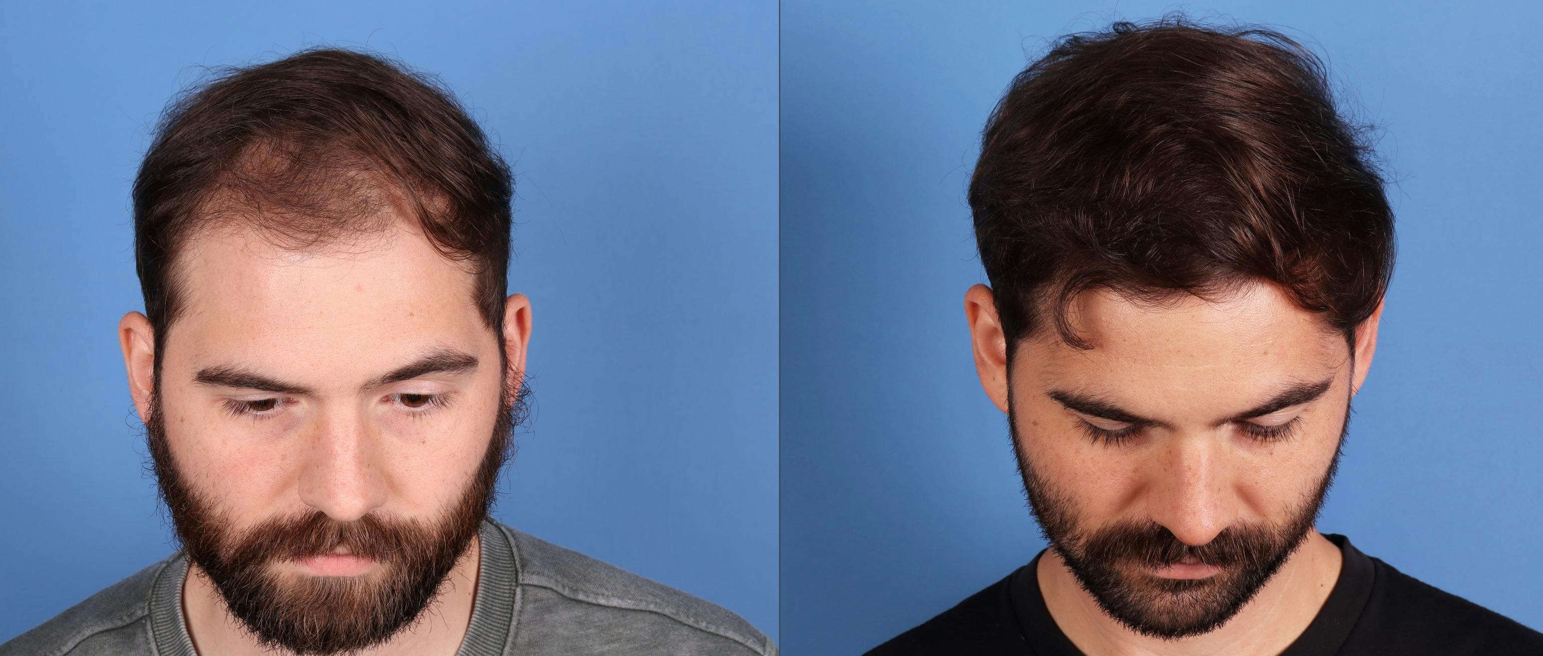 NeoGraft Hair Restoration Before & After Gallery - Patient 120198 - Image 6