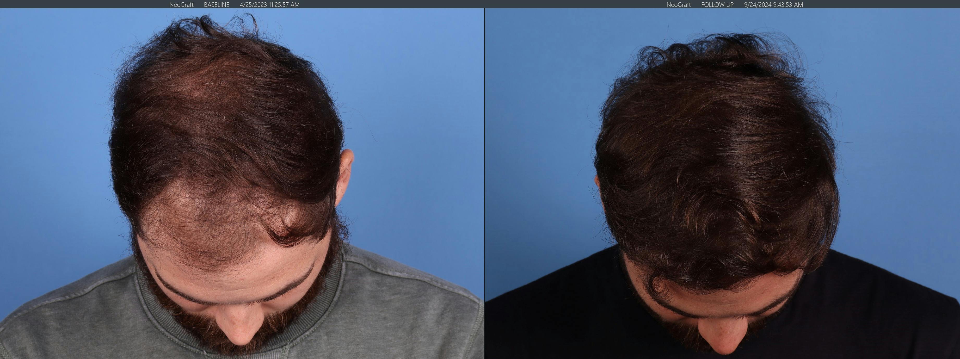NeoGraft Hair Restoration Before & After Gallery - Patient 120198 - Image 7