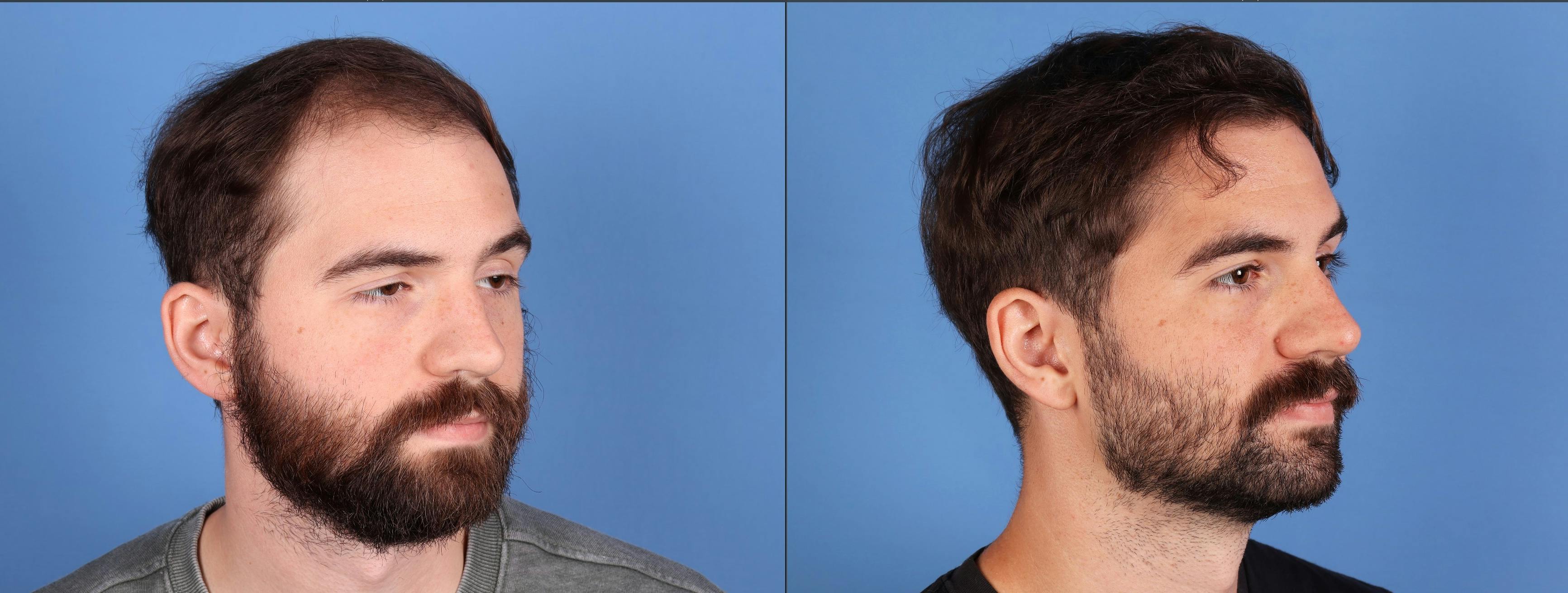 NeoGraft Hair Restoration Before & After Gallery - Patient 120198 - Image 4