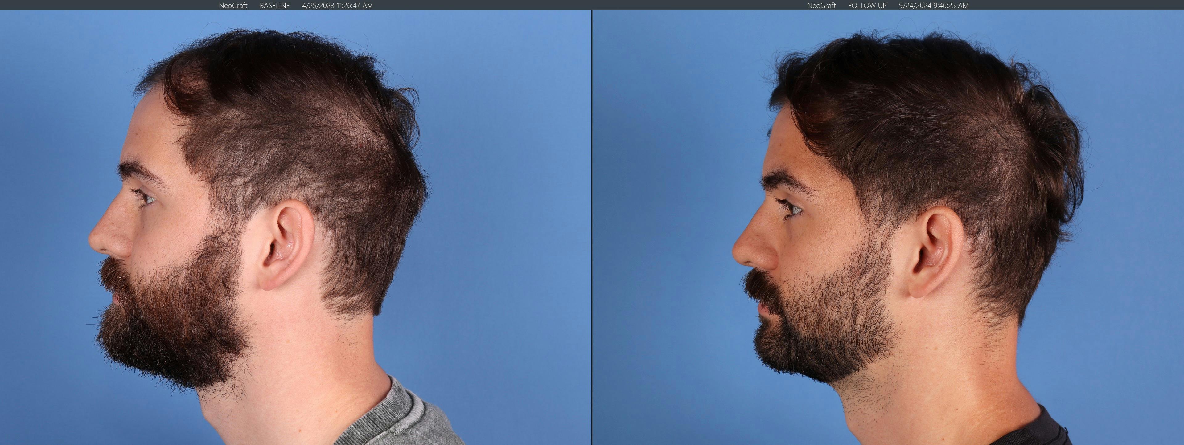 NeoGraft Hair Restoration Before & After Gallery - Patient 120198 - Image 3