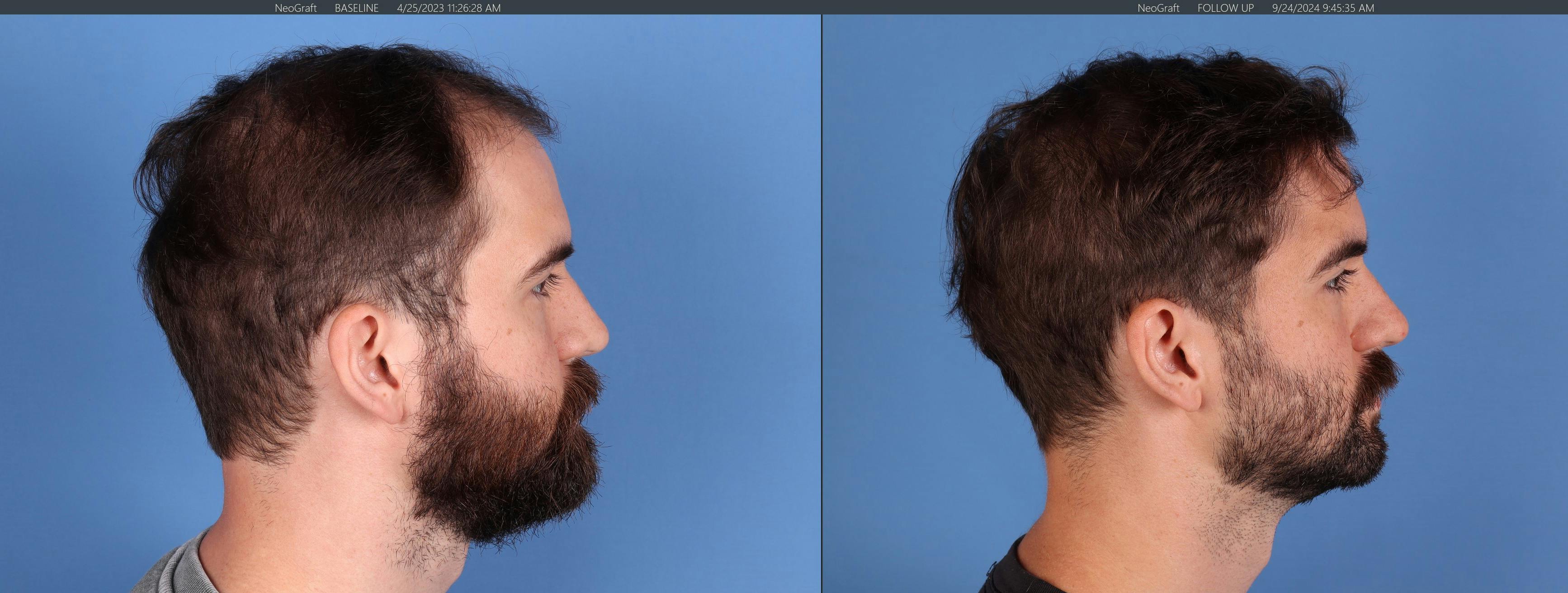 NeoGraft Hair Restoration Before & After Gallery - Patient 120198 - Image 5