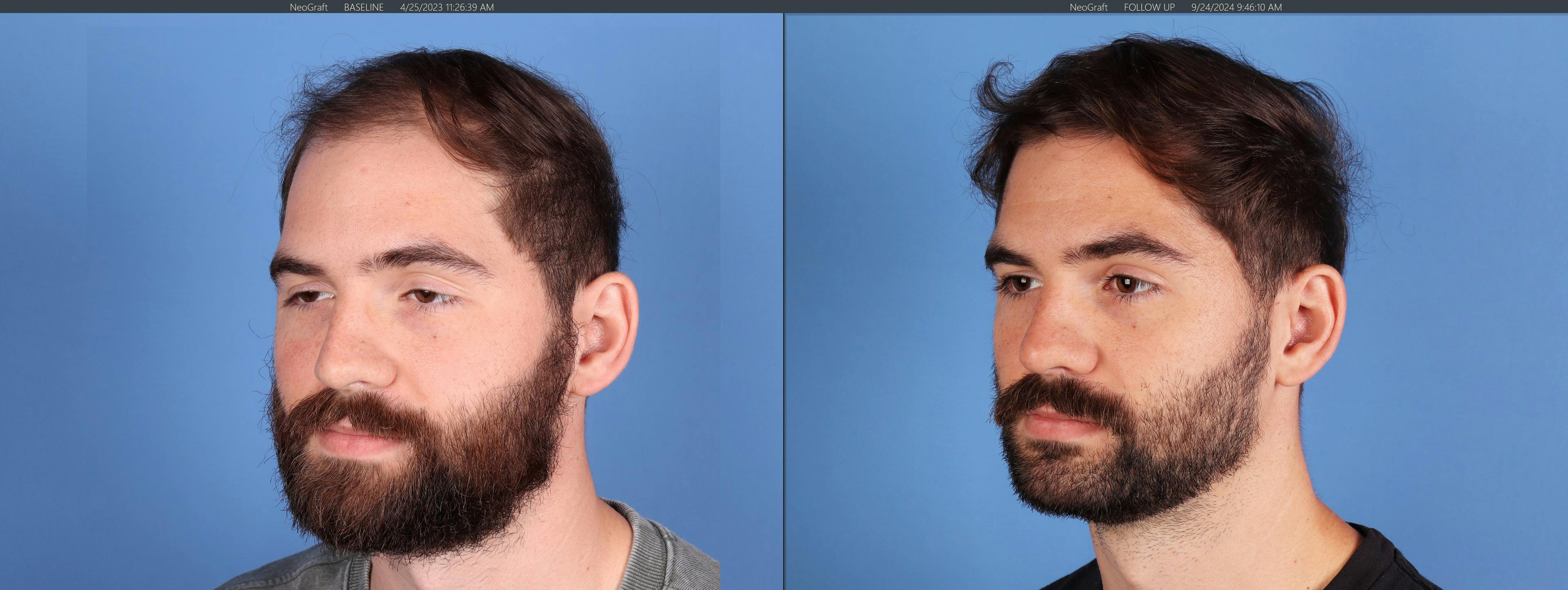 NeoGraft Hair Restoration Before & After Gallery - Patient 120198 - Image 2