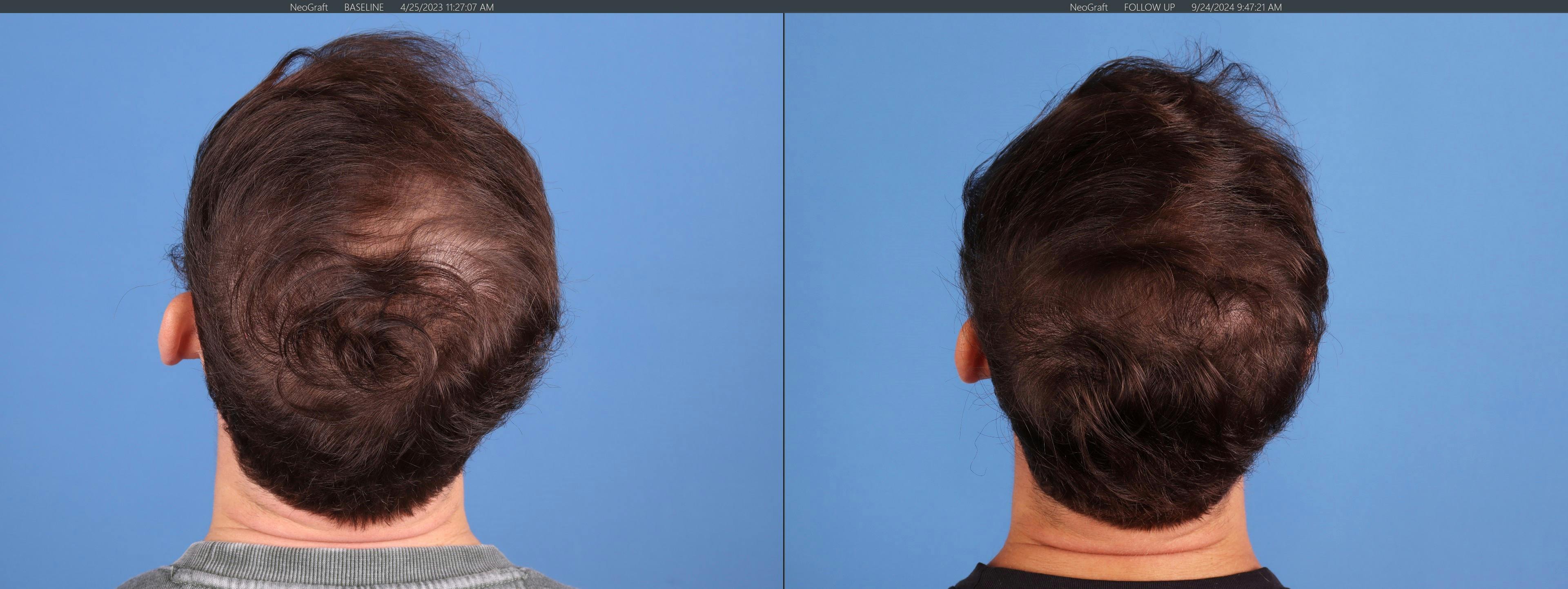 NeoGraft Hair Restoration Before & After Gallery - Patient 120198 - Image 8