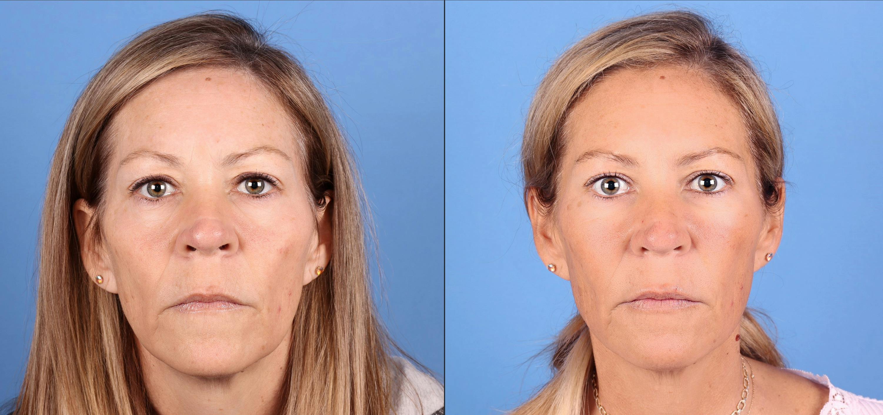 Facial Fillers Before & After Gallery - Patient 140349 - Image 1