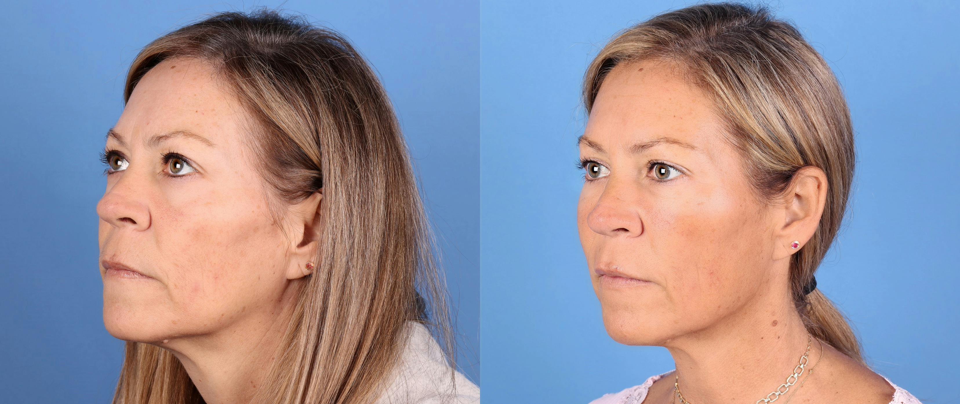 Facial Fillers Before & After Gallery - Patient 140349 - Image 2