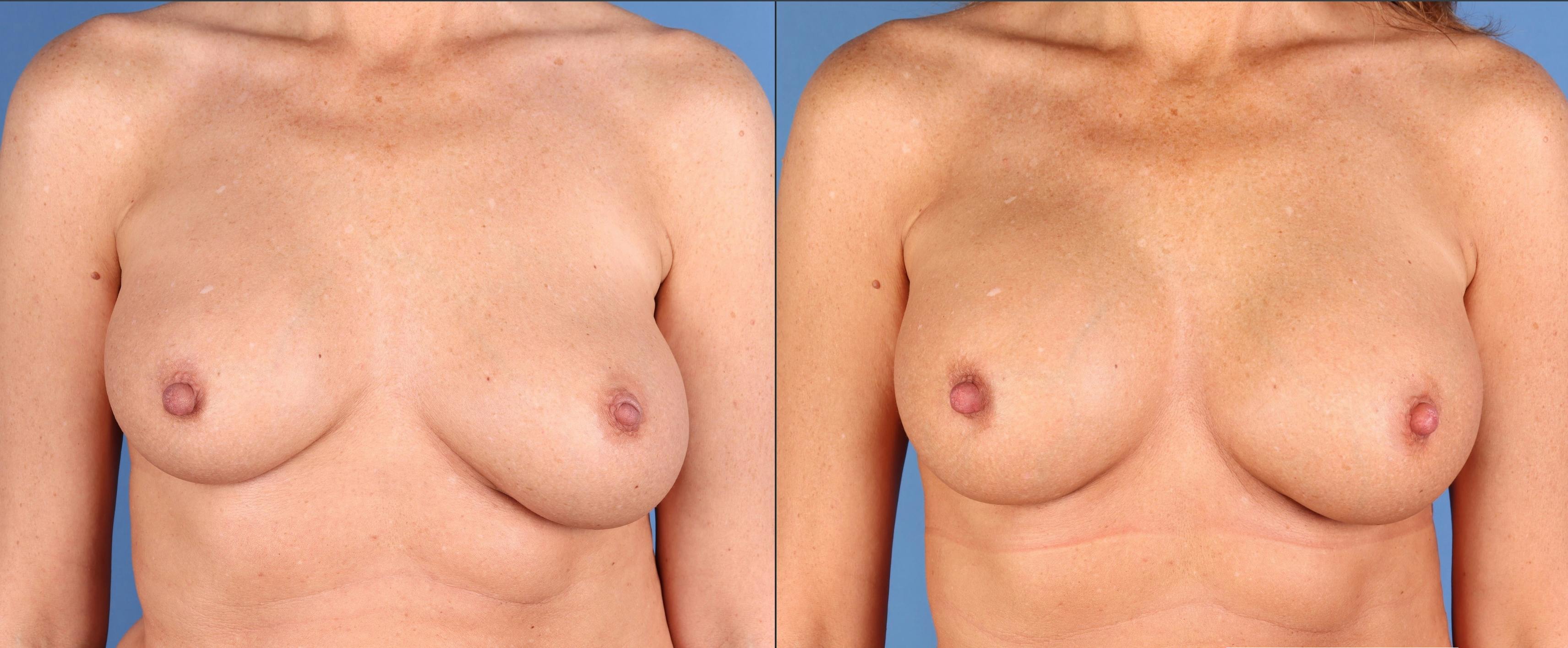 Breast Revision Before & After Gallery - Patient 268694 - Image 1