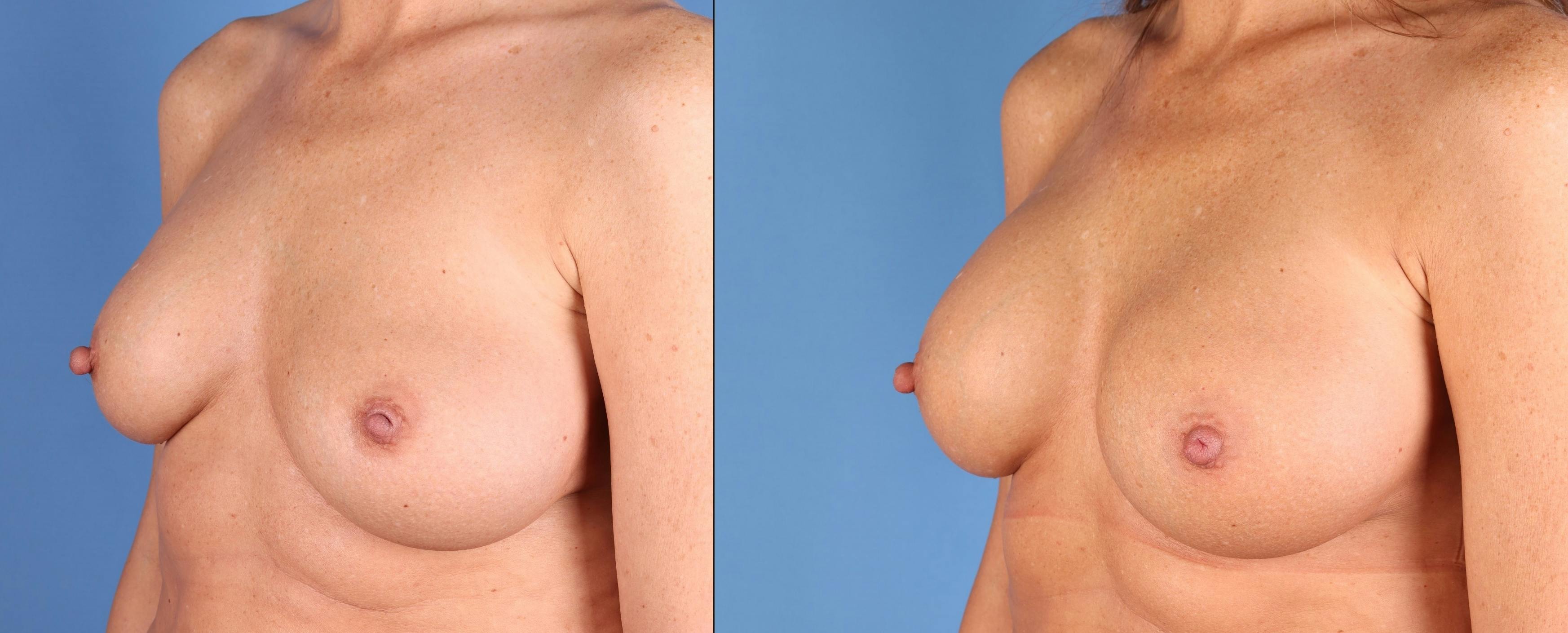 Breast Revision Before & After Gallery - Patient 268694 - Image 2
