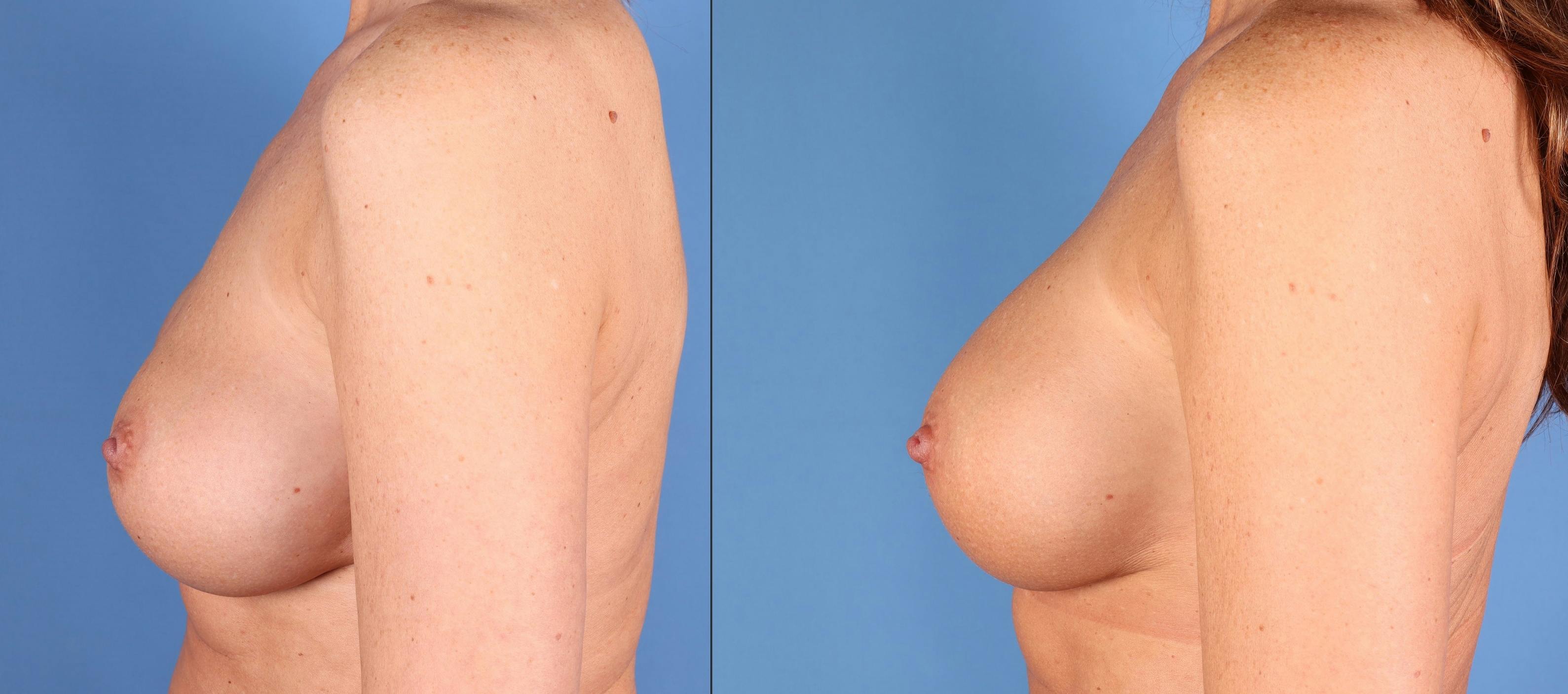 Breast Revision Before & After Gallery - Patient 268694 - Image 3