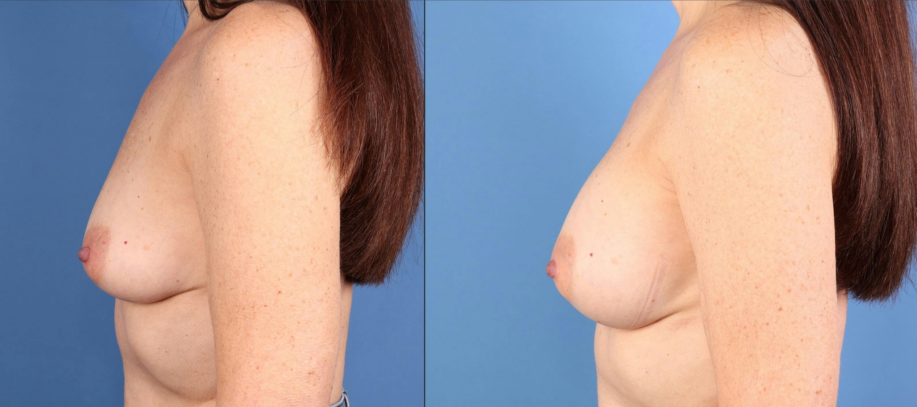 Breast Augmentation Before & After Gallery - Patient 313647 - Image 3