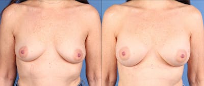 Breast Augmentation Before & After Gallery - Patient 313647 - Image 1