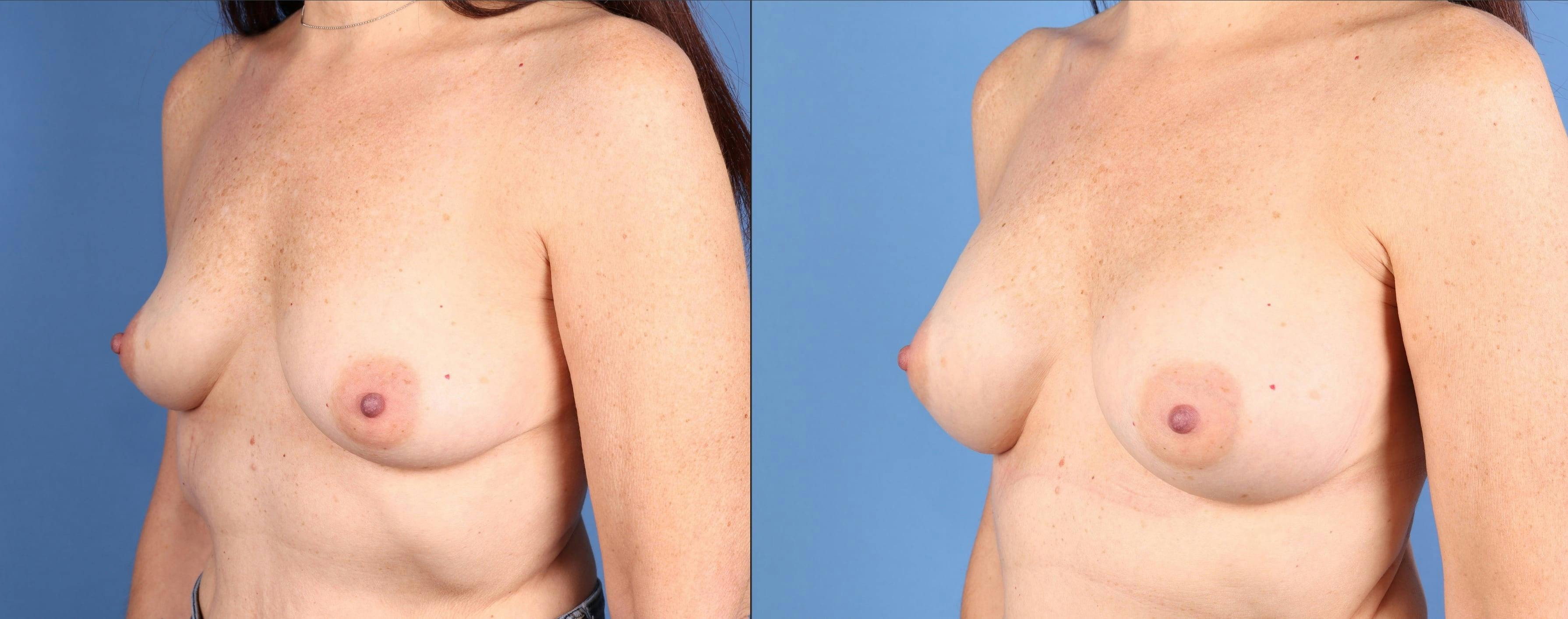 Breast Augmentation Before & After Gallery - Patient 313647 - Image 2