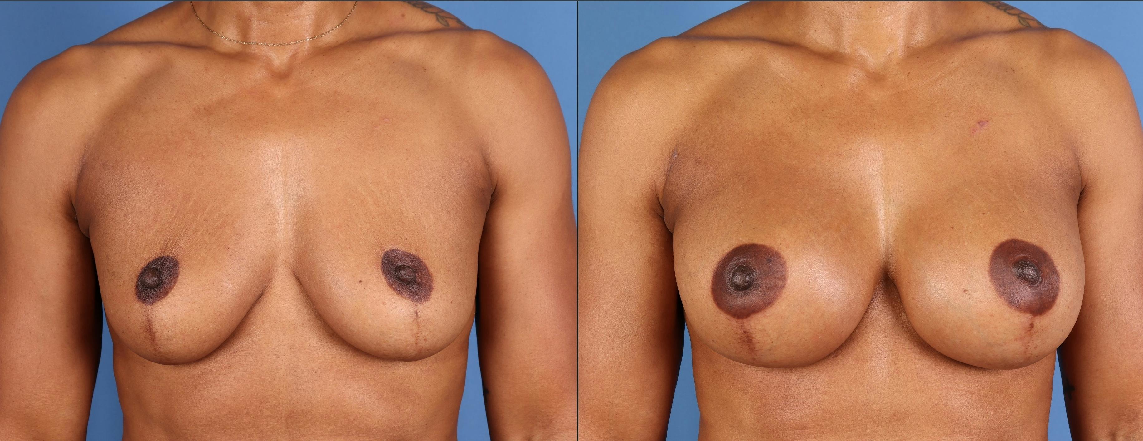 Breast Augmentation Before & After Gallery - Patient 168047 - Image 1