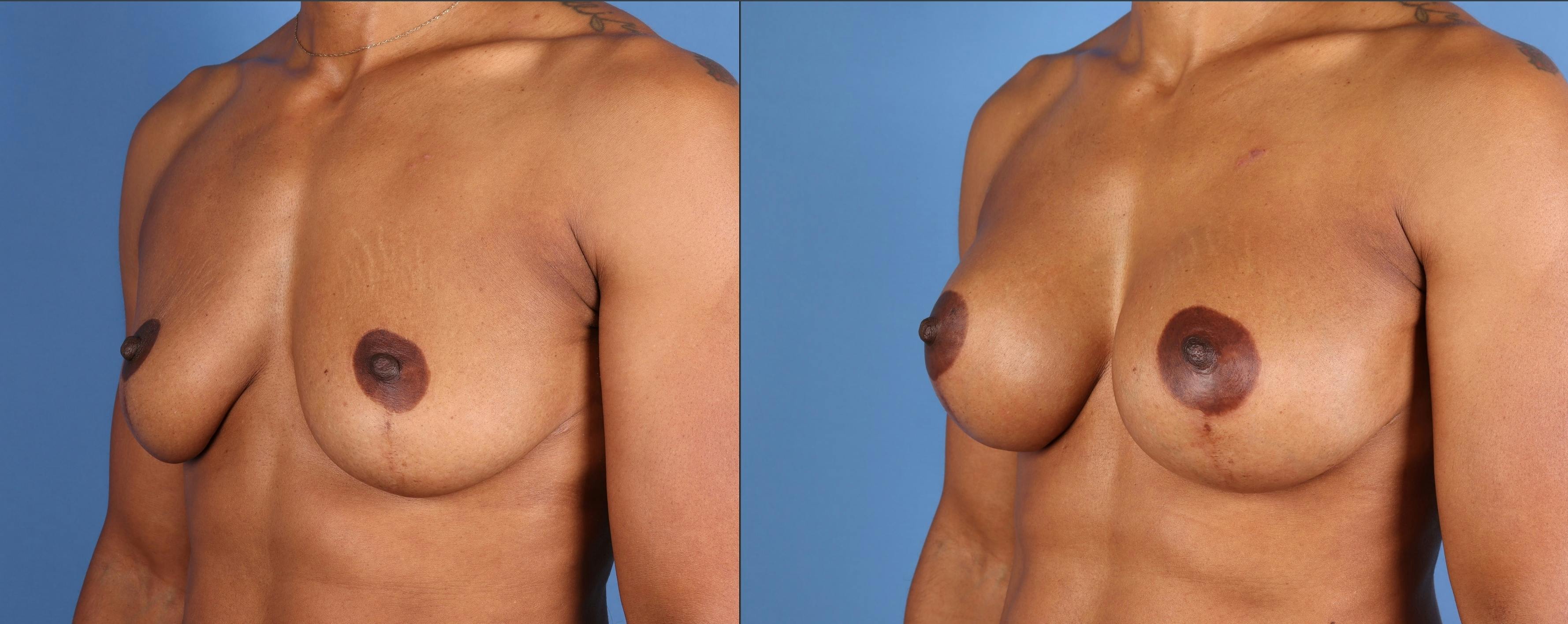 Breast Augmentation Before & After Gallery - Patient 168047 - Image 2