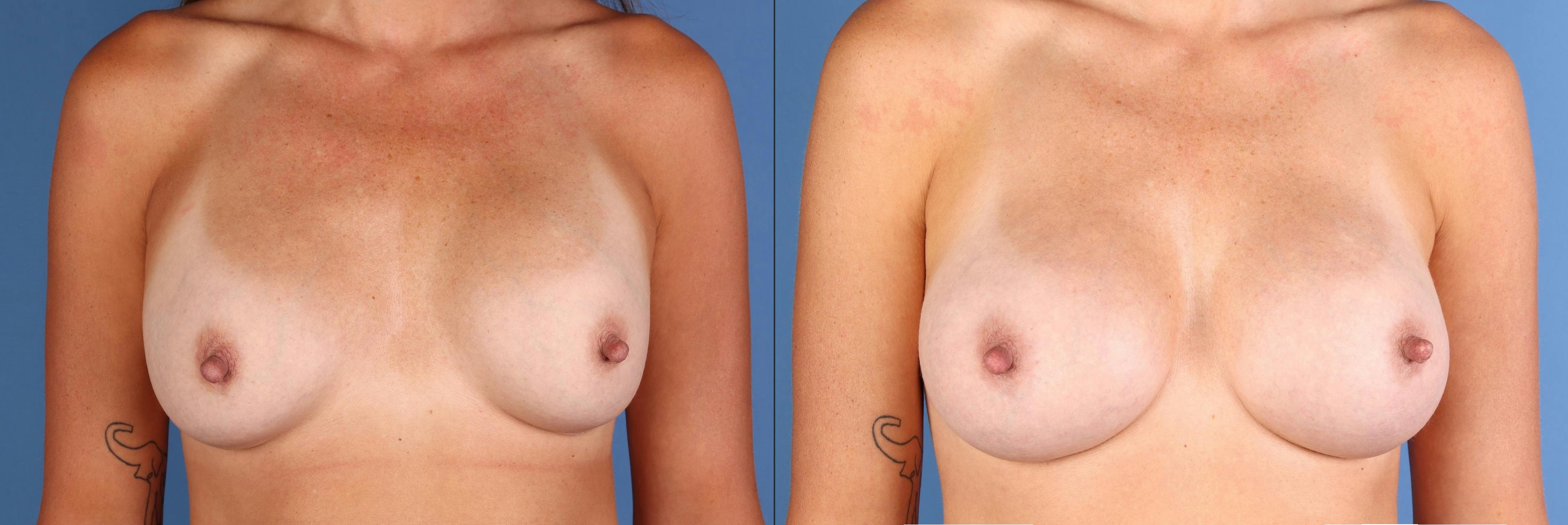 Breast Augmentation Before & After Gallery - Patient 239283 - Image 1