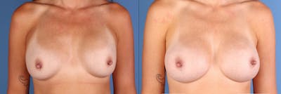Breast Augmentation Before & After Gallery - Patient 239283 - Image 1