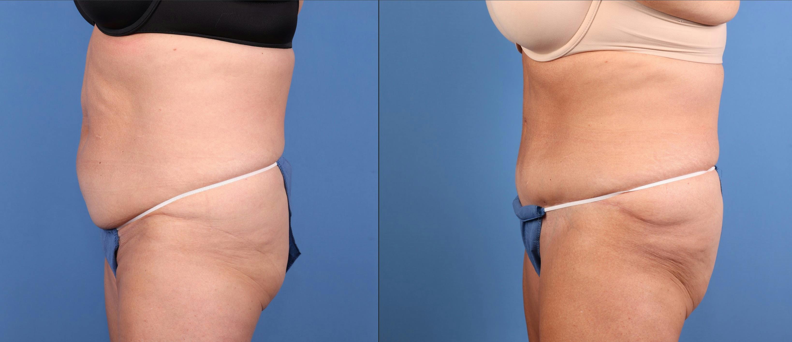 Tummy Tuck Before & After Gallery - Patient 118227 - Image 3