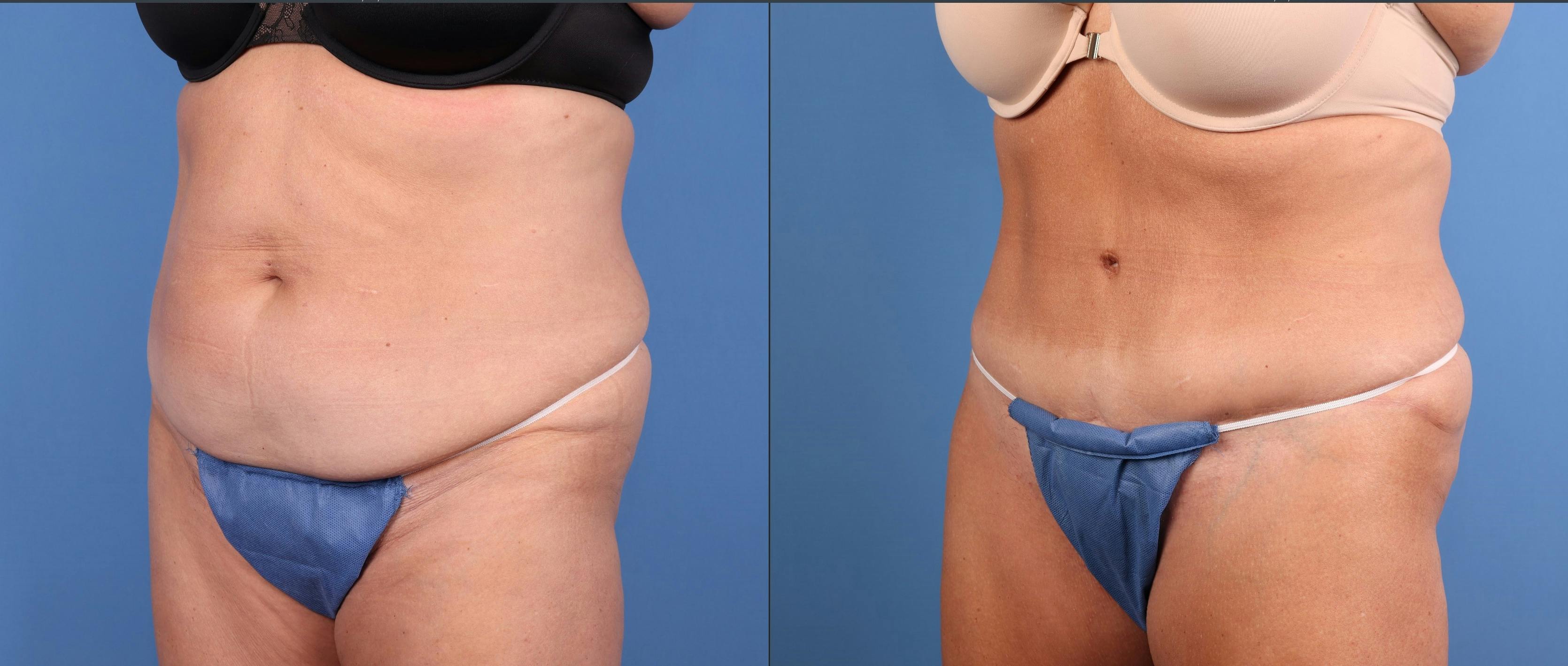 Tummy Tuck Before & After Gallery - Patient 118227 - Image 2